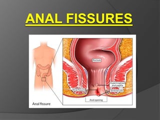 Anal fissure pain after bowel