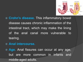 Anal fissure pain after bowel