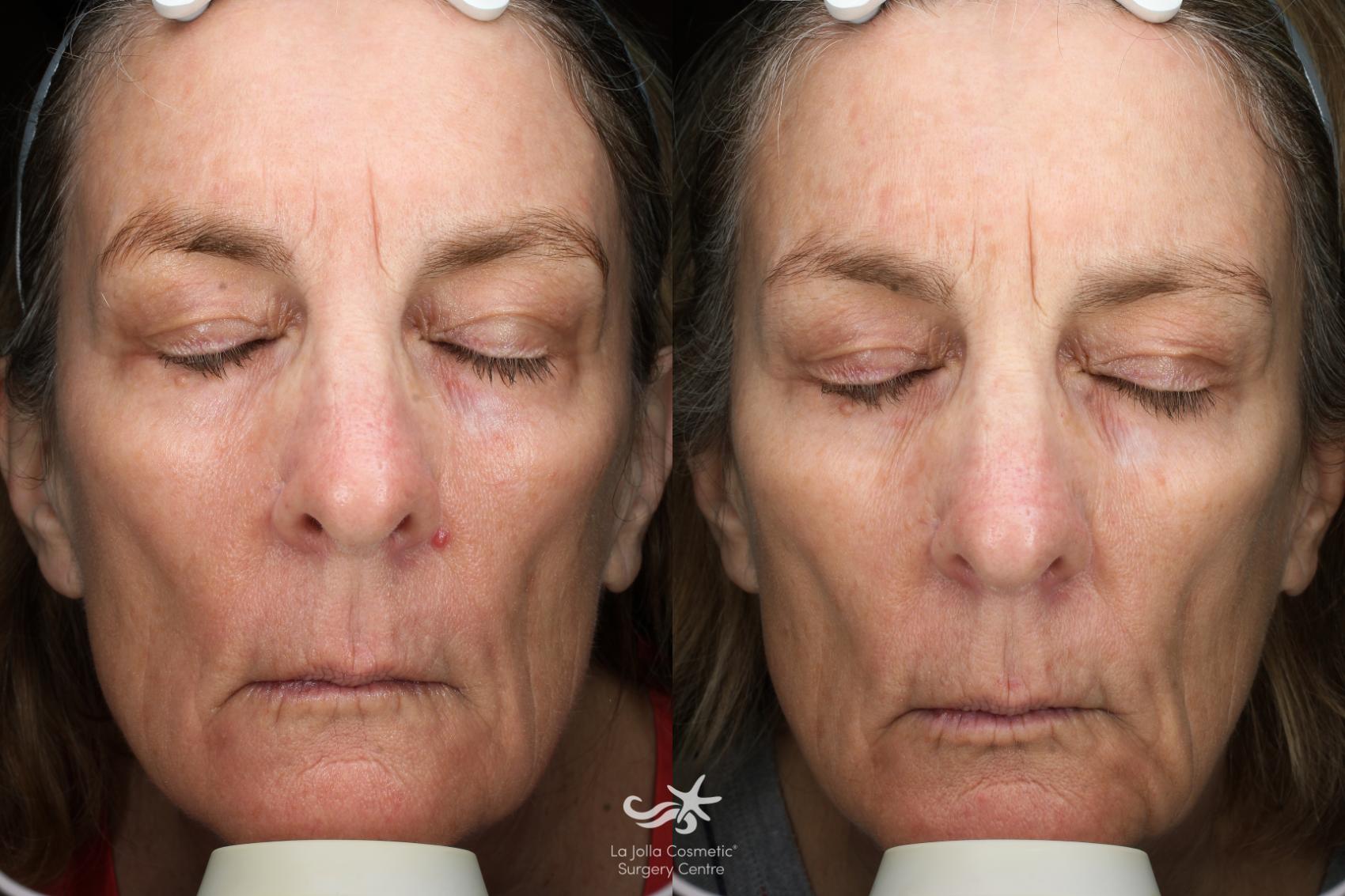 Facial resurfacing colorado