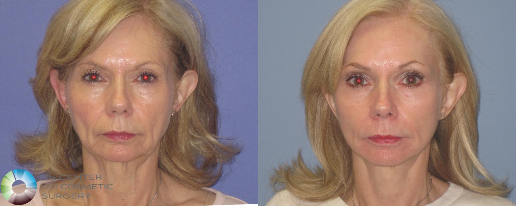 best of Colorado facial resurfacing